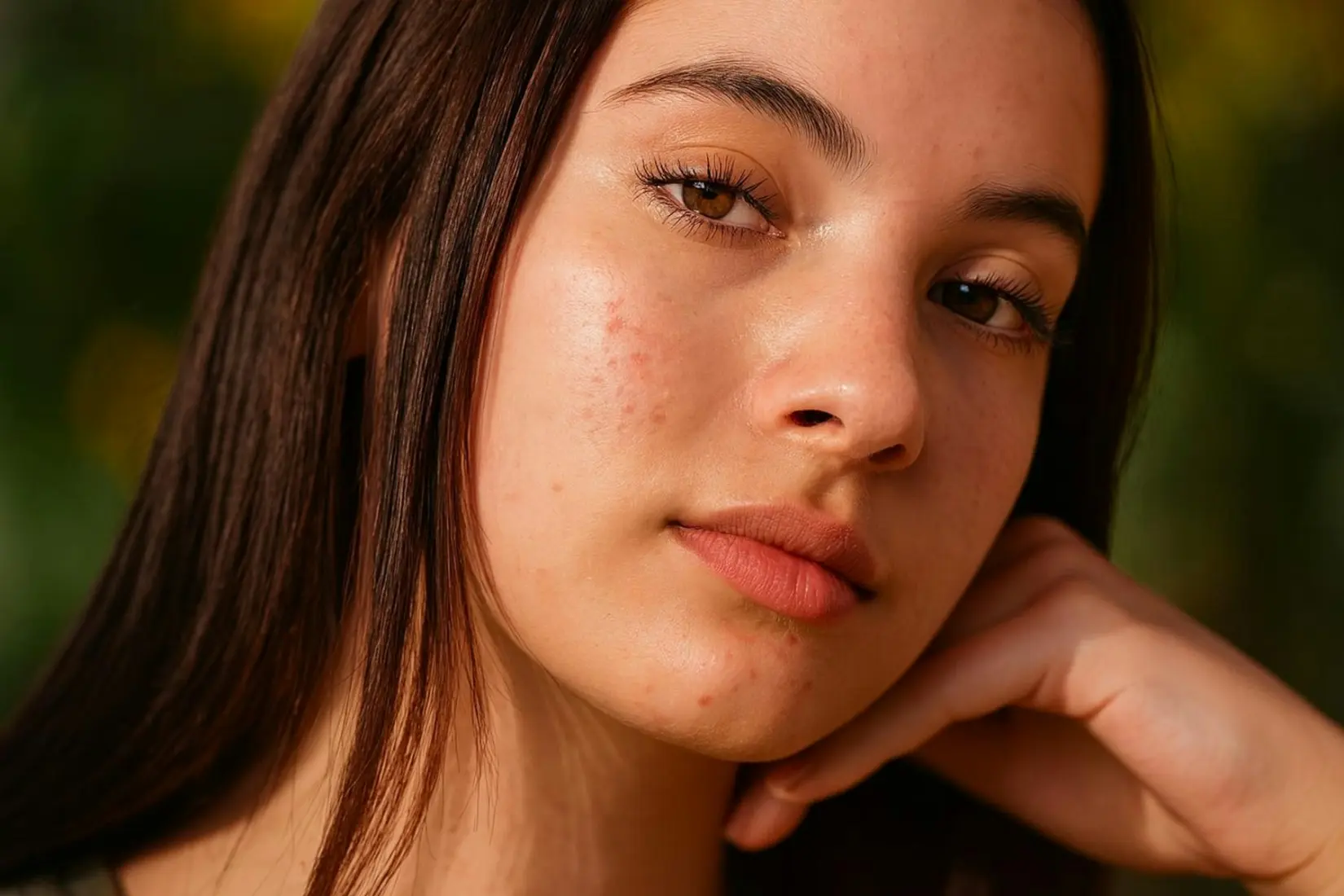 Young woman with a few cheek blemishes resting chin on hand